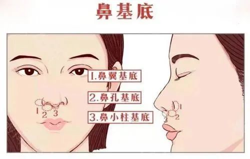 鼻基底整形的方法有哪些？