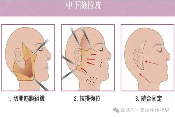 拉皮手术能剥离到法令纹部位么？