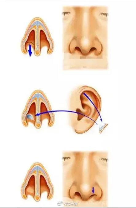 秋季儿童过敏性紫癜高发，治疗药物一览