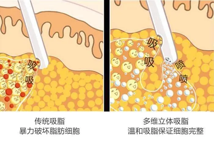 抽脂后变成植物人卧床4年没有人形？土耳其美女被整容毁了……