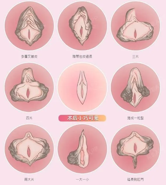 女性私密健康：揭秘常见私处分泌物及其预防措施